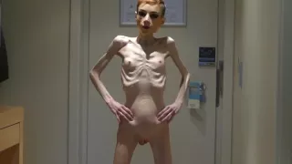Anorexia Christin showing her Bones & Skinny Skeleton