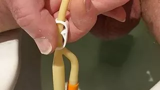 Bladder squeeze then drain with Fr16 catheter