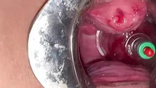 Uterine mouth suction