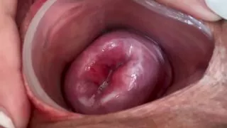 Small cervix without dilating