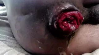 Destroying my ass again episode of anal prolapse series ASS P3 PUMP