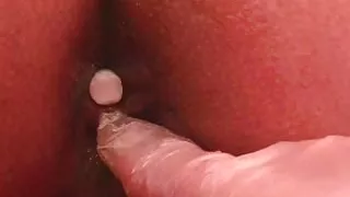 Cutouts: Treatment with laxative suppositories and enemas