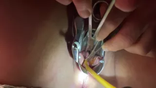 Tenaculum Grasping Cervix For Catheter 7 Min