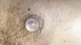 Supple Cups filling up with Serous fluid