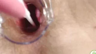 Gyno exam with speculum close up in hairy pussy