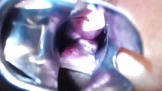 Speculum Cervix & Anal Exam Great View Inside