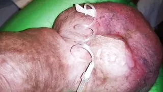 Another Extreme Filling up with Glucose