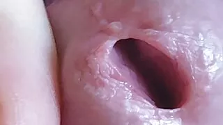 Incredible Hole covered by phimosis hinders the young boy.