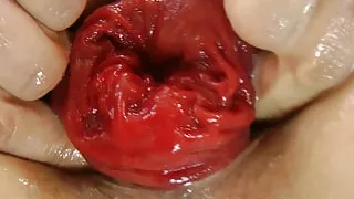 Sindy Rose Self Anal Fisting & Ruined Asshole Prolapse