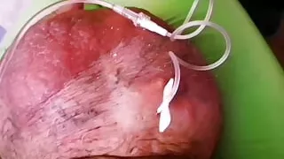 Another Extreme Filling up with Glucose