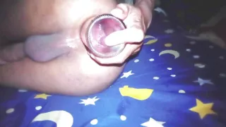 fisting anal gaping and prolapse
