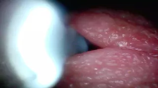 Endoscope camera captures moment of male ejaculation