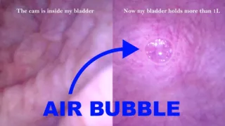 POV Endoscope Catheter Bladder Inflation