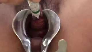 Super glue on the bladder and urethra closed and unable to pee