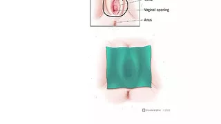 How to Use a Dental Dam