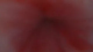 Endoscope from urethral opening to bladder