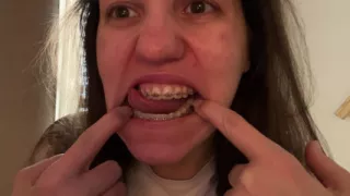 Licking Your Braces with Your Tongue