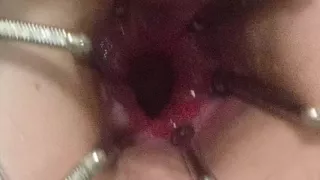 Enema, anal shower. Close-up view through anal mirror. Anal with water. Filling anal with water