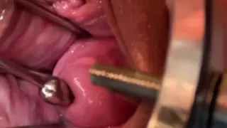 Exploring My Cervix With Sound And Fingers