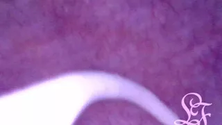 Can I fit the minicam AND a catheter inside my pee hole at the same time?