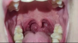 A Close-up of My Throat