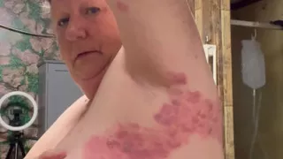 Bad Case of Shingles