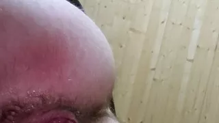 Anal Prolapse,Anal