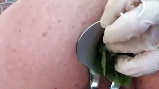 Nettles Ass Fisting Anal Insertion Nettles with Speculum