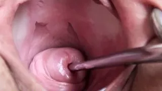 Extreme Real Cervix Fucking Insertion Objects in Utherus