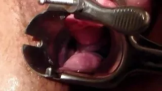 dilatation au speculum