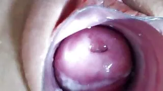 Cervix