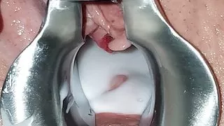 My wife's spunk filled speculum spread pussy