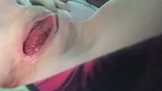 Pregnant cervix prolapse