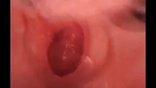 Pregnant cervix prolapse 2