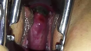 Deep view inside woman with speculum, nice view of cervix