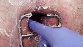 Marcus Pollack opens a hungry hole with speculum