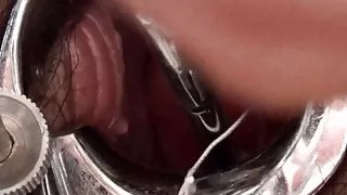 Laminary (kelp) stick insertion in the cervix