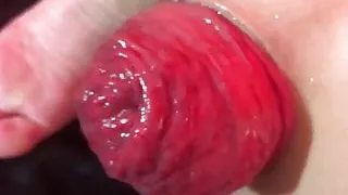 Huge anal prolapse ruined very closeup