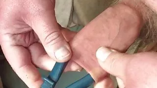 Foreskin with large blue pliers