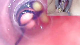 Mature Woman, Peehole Endoscope Camera in Bladder with Balls
