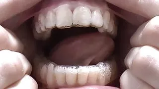 Release For My Plastic Retainer