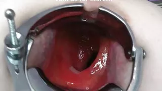 Dirtygardengirl anal & pussy speculum & prolapse extreme