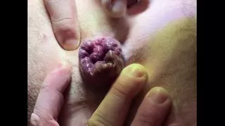 Small prolapse and anal play