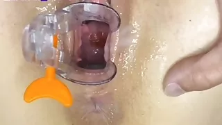 Wife's insemination into the womb with speculum