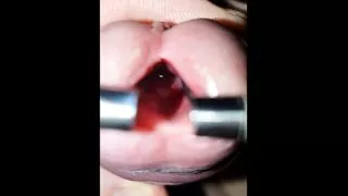 young urethra stretching to maximum, look inside and 10mm dilator inside