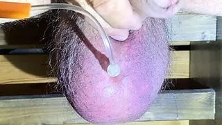 Saline Glucose Infusion 1 Liter