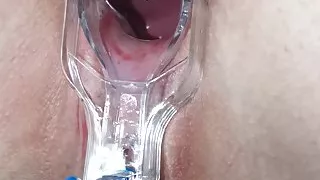 Examination of the cervix